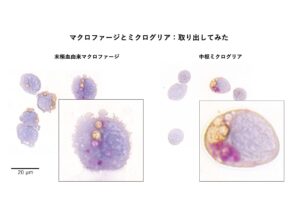 【03. マクロファージとミクログリア:取り出してみた】
実験的自己免疫性脳脊髄炎(EAE)マウス脊髄からセルソーターでF4/80+CD45+末梢血由来マクロファージとF4/80+CD45dim中枢ミクログリアを採取しサイトスピンサンプルを作成した。どちらも髄鞘蛋白(褐色)を貪食しているが、一部はPAS陽性顆粒に変性している。ミクログリアは大きな顆粒を貪食しているのに対し、マクロファージ内では消化が進み泡沫状を呈している。マクロファージの細胞表面は多数の足突起に覆われているが、ミクログリアの細胞膜は平滑である。